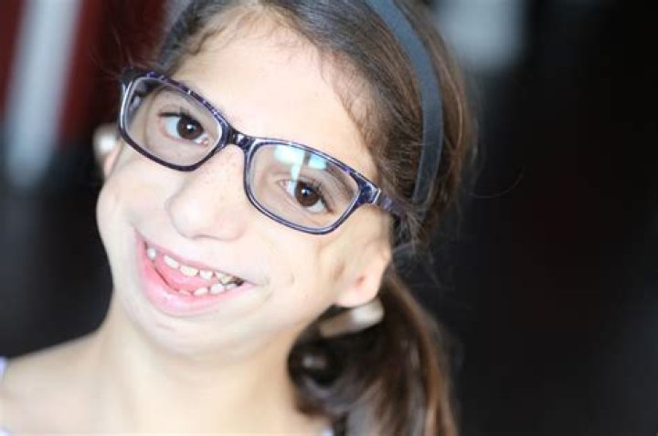 سندروم تریچر کالینز (Treacher Collins syndrome)چیست؟ همه چیز درمورد آن