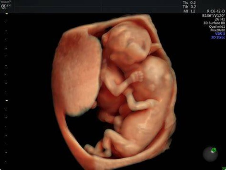 (26) 30 week twin update surrogate journey 2 YouTube