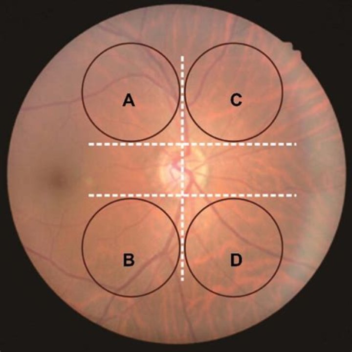 3 Areas & Under Eye (Jelly Roll) Anti Wrinkle (Botox) Before, During