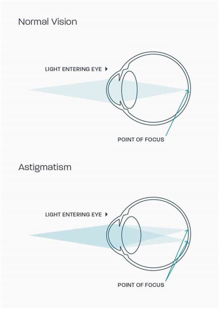 A Complete Guide to Astigmatism Symptoms, Causes.
