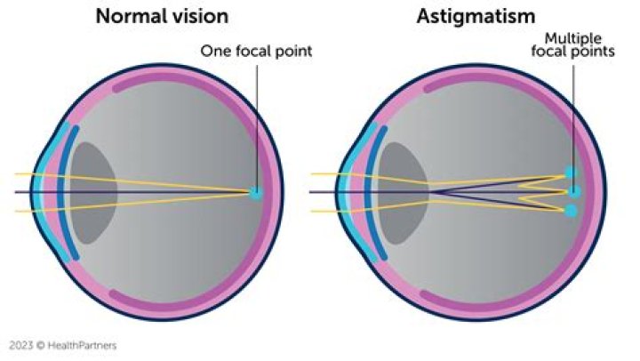 A Guide To How Astigmatism Lights Look Blog Eyebuydirect