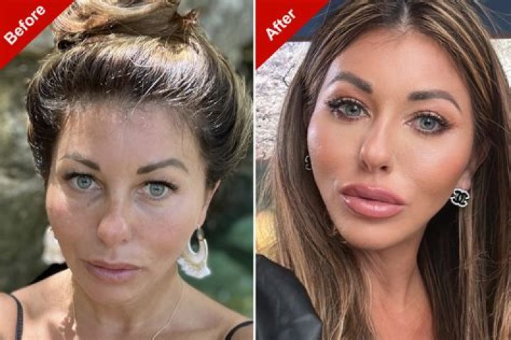 Alexis Maloney Plastic Surgery Botox, Fillers, Before After