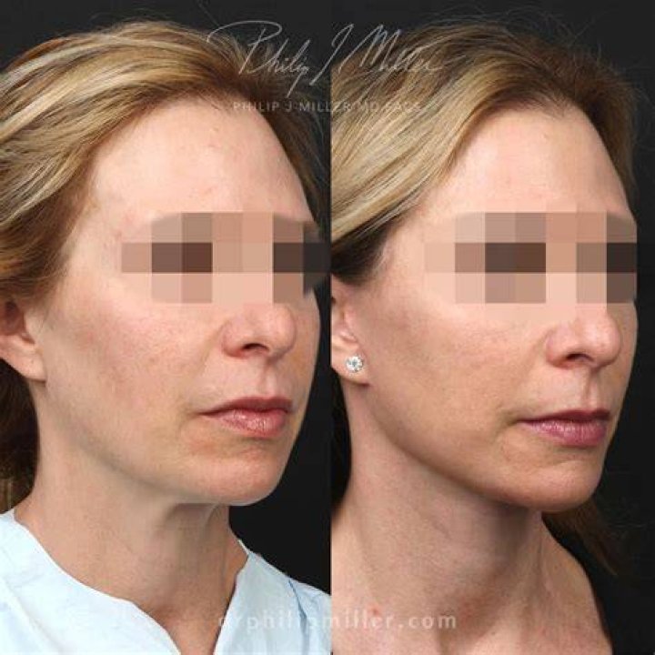 Ali Liebert Plastic Surgery Facelift, Lips, Botox, and More