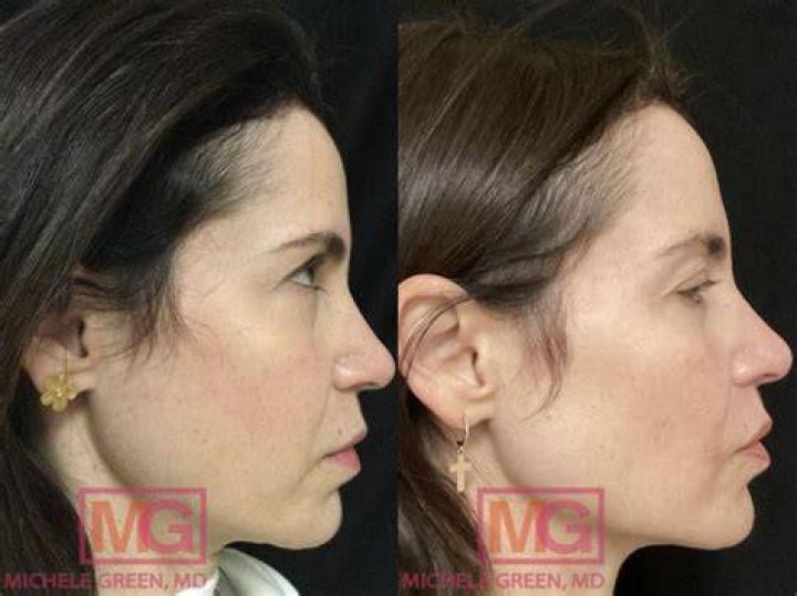 ArnoldSchwarzeneggerBeforeAndAfterPlasticSurgery8 PearlMD