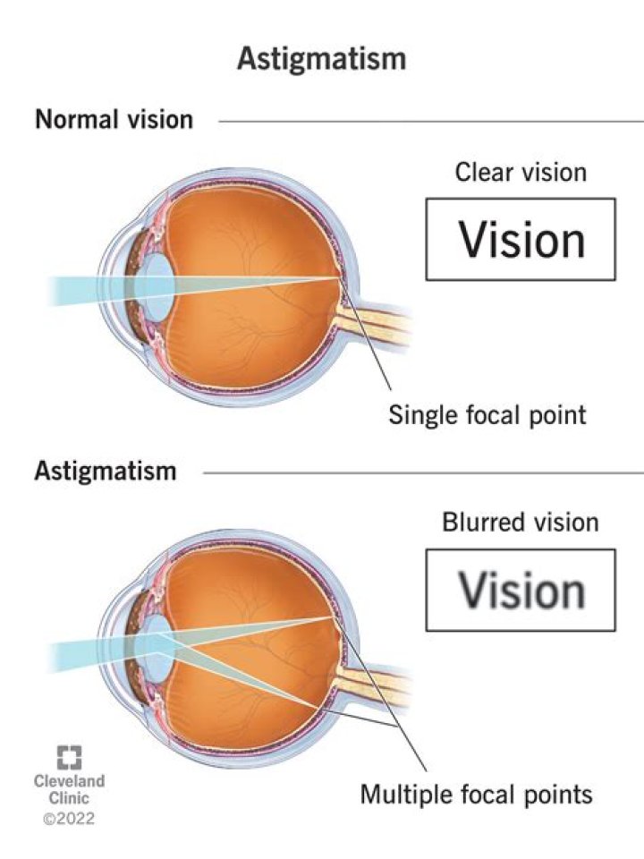 Astigmatism causes Blurred Vision First Eye Care Downtown Dallas