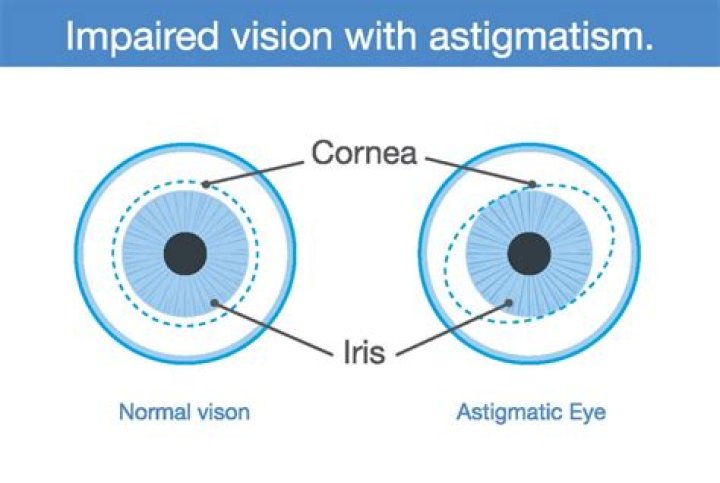 Astigmatism First Eye Care Downtown Dallas