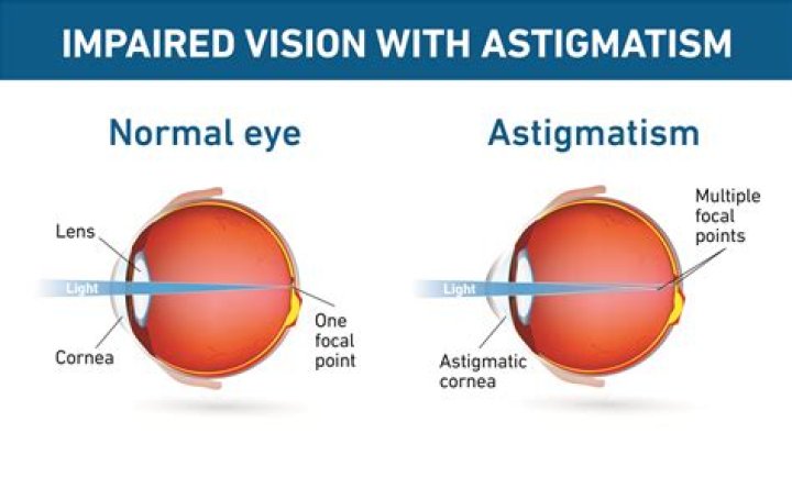Astigmatism How it can Impact Night Vision and Driving Dr. Jiwani