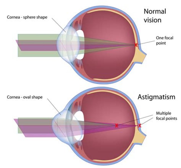 Astigmatism Petrou Eye Care