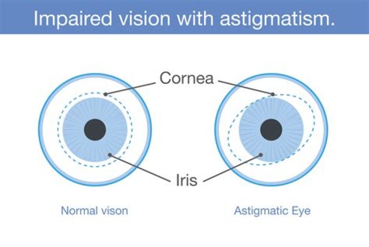 Astigmatism The Canadian Association of Optometrists