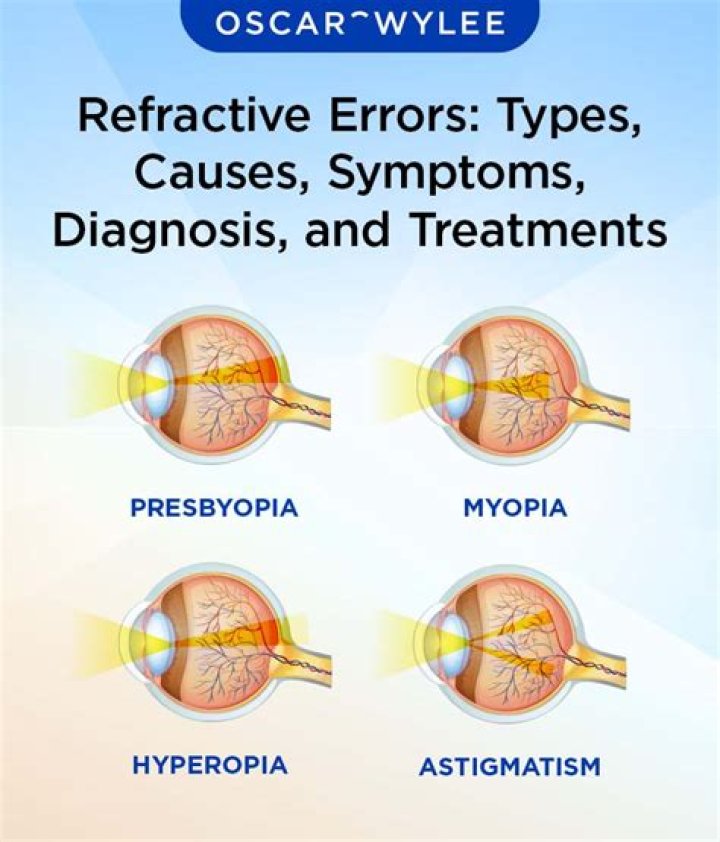 AstigmatismCausesTypesSymptomsTreatment Lenses, Refractive Surgery