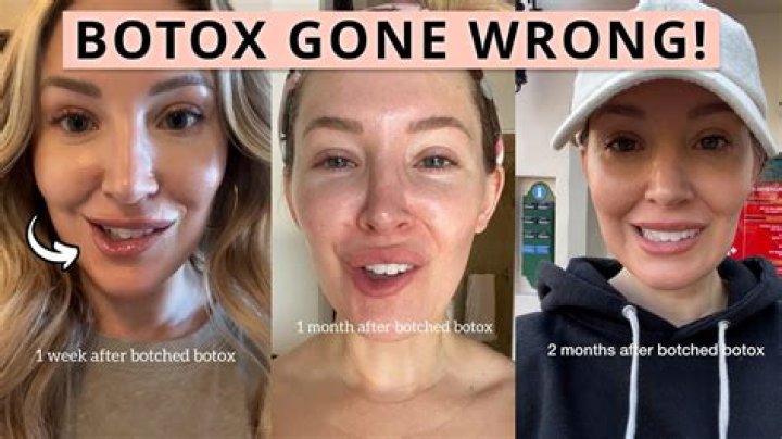 Bad Botox Know What it Looks Like and How to Protect Yourself