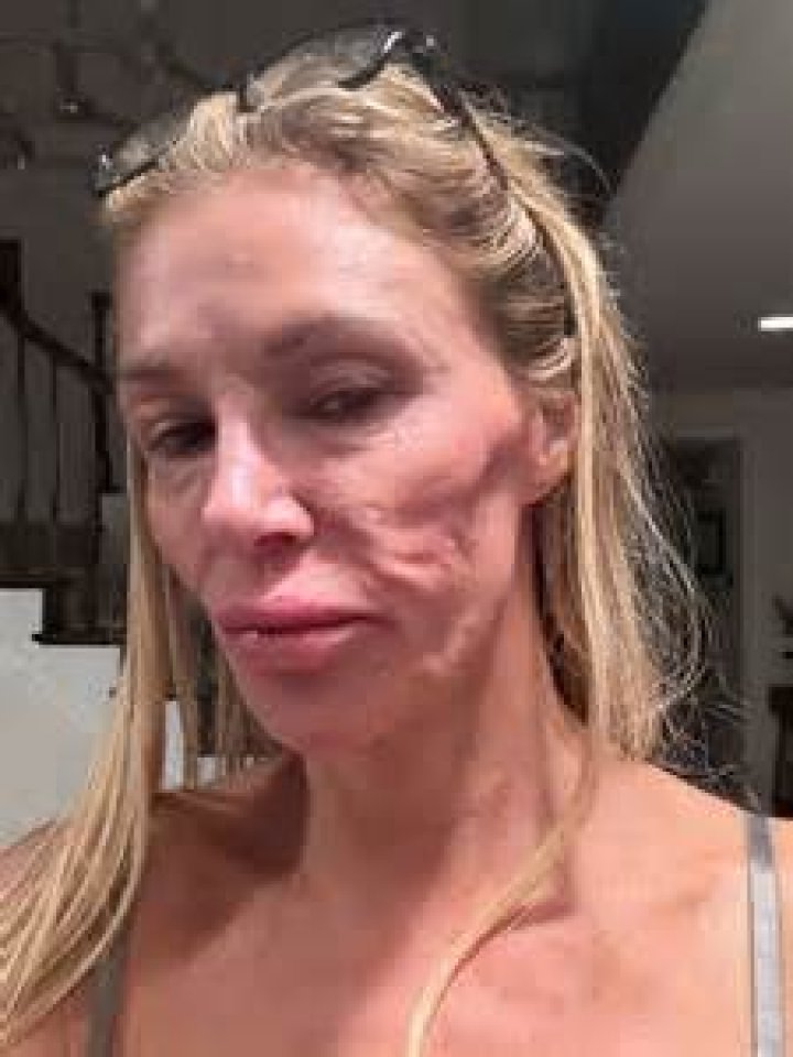 Brandy Renee Before Surgery Plastic Surgery Transformation
