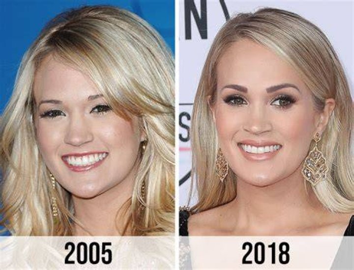 Carrie Underwood Plastic Surgery Before And After Photos