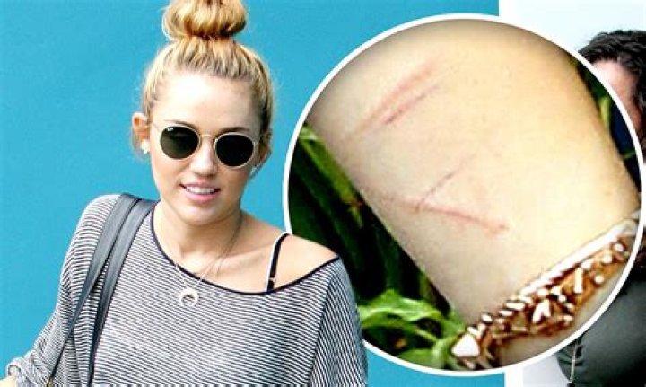 Celebrities With Self Harm Scars Our Vinyl Weighs A Ton