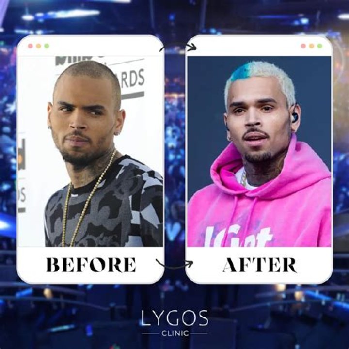 Chris Brown Losing Hair Chris Brown Accused Of Striking Woman At