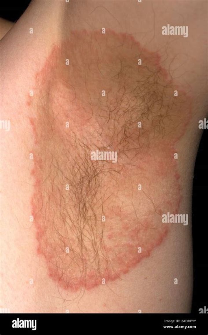Circular Rash Under Armpit