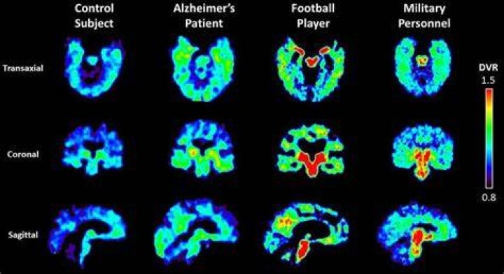 CTE Study Finds Evidence of Brain Disease in 110 Out of 111 Former NFL