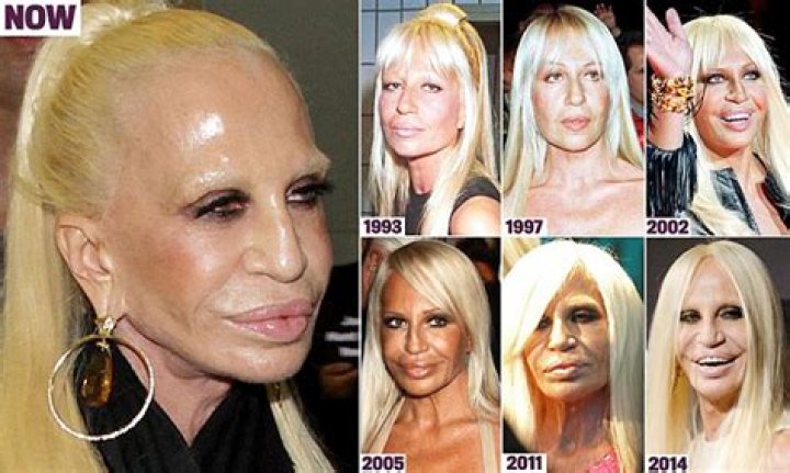 Donatella Versace Before and After Plastic Surgery Vanity