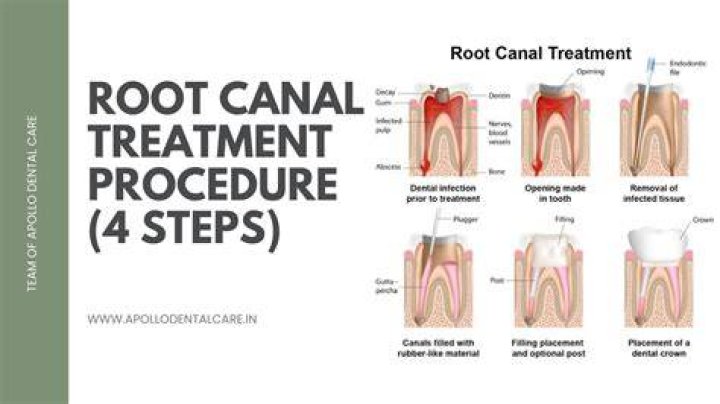 Dr. Dennis Tucker Root Canal Dentist St. Cloud Root Canal