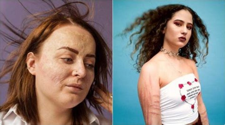 Embrace your scars and flaunt them, for they too have a story