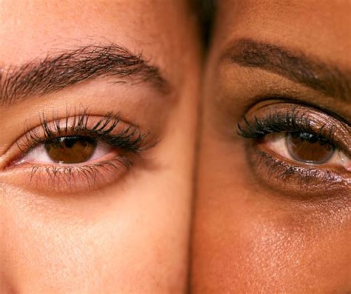 Forest Whitaker’s Eye Explained by an Eyelid Surgeon Understanding