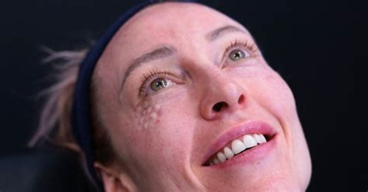 Jelly Roll Botox A Guide for Effective Results BeautyKylie