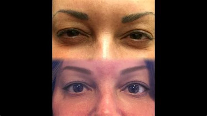 Jelly Roll Botox YouTube
