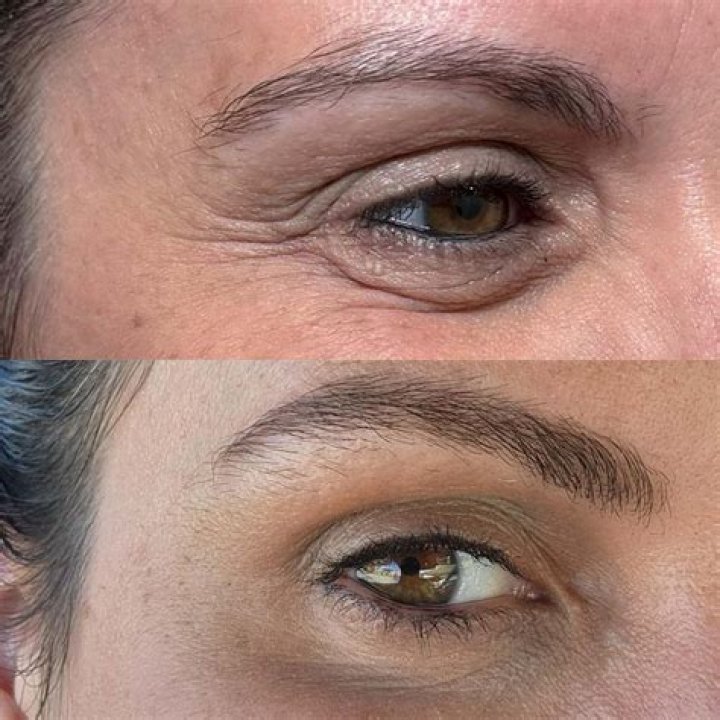 Jelly Roll Botox&reg; Under Eye Fixes IAPAM