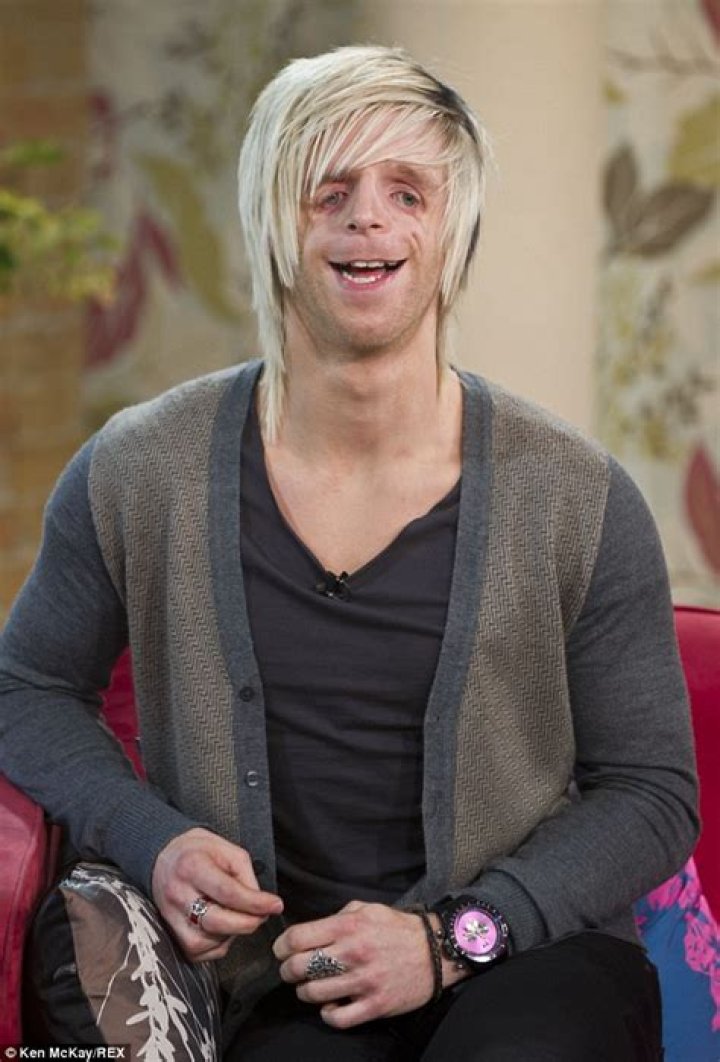 Jono Lancaster meets boy who suffers same disorder Daily Mail