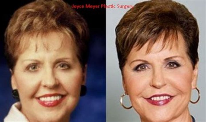Joyce Meyer Plastic Surgery, Really?