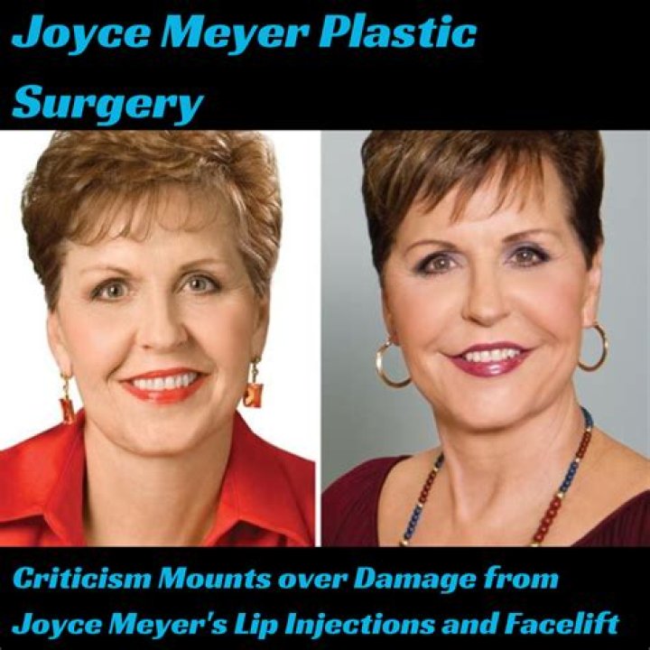 Joyce Meyer&rsquo;s Plastic Surgery The Author/Speaker Has Never Admitted to