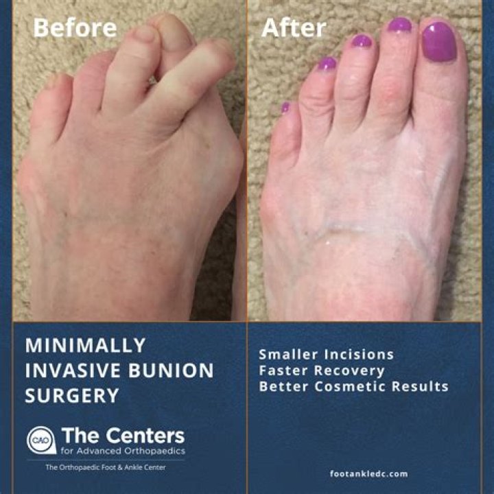 Kathy Lee Reveals Bunion Surgery on Facebook Foot and Ankle Center of