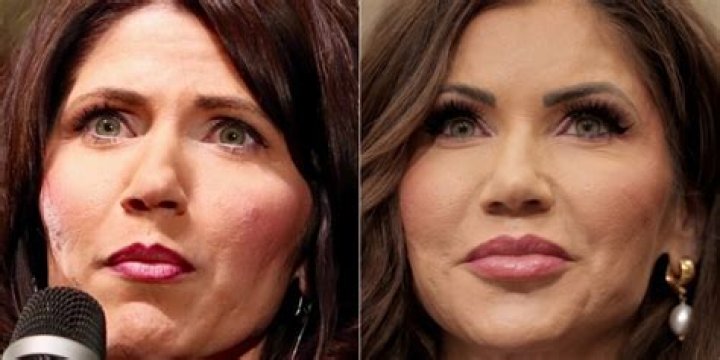 Kristi Noem Plastic Surgery Before & After Pictures Depicts A Clear