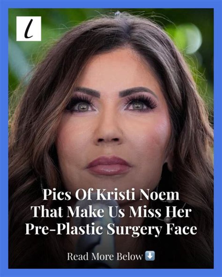 Kristi Noem’s Plastic Surgery Couldn’t Be More Obvious to Viewers in