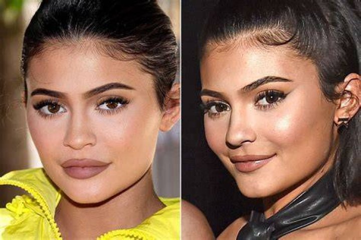 Kylie Jenner Lip Fillers Plastic Surgery Before and After Photos 