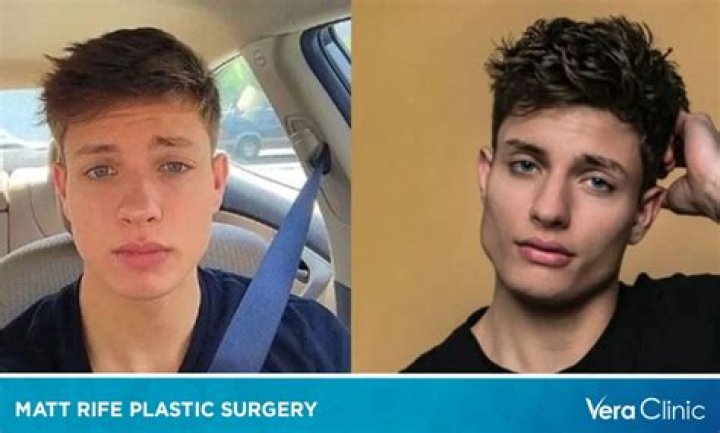 Matt Rife Plastic Surgery & Weight Loss. Glow Up And Before After Pictures.