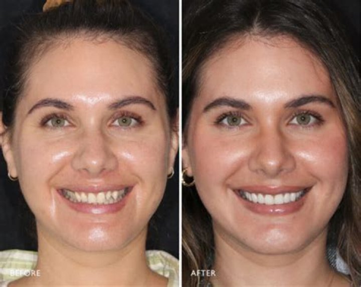 Nany Gonzalez Before And After Veneers Transformation