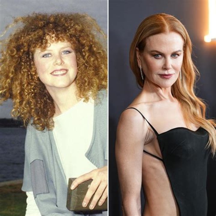 Nicole Kidman before and after plastic surgery (21) Celebrity plastic