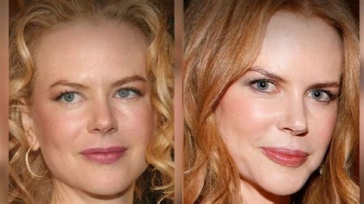 Nicole Kidman Plastic Surgery Before After Pics