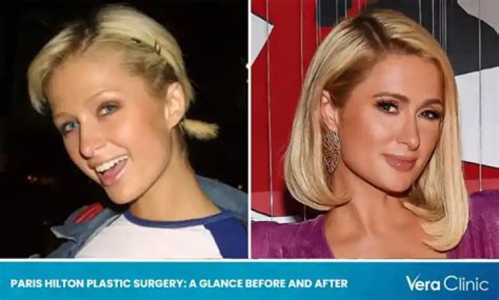 Paris Hilton Nose Job Plastic Surgery Before And After Rhinoplasty
