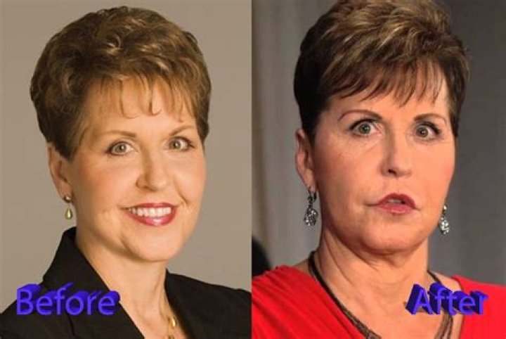 Photo Of Joyce Meyers Before Plastic Surgery