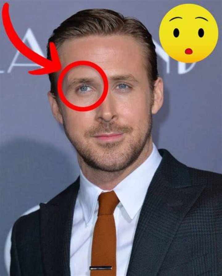 Pictures Celebrities with a Lazy Eye Celebrities With Amblyopia