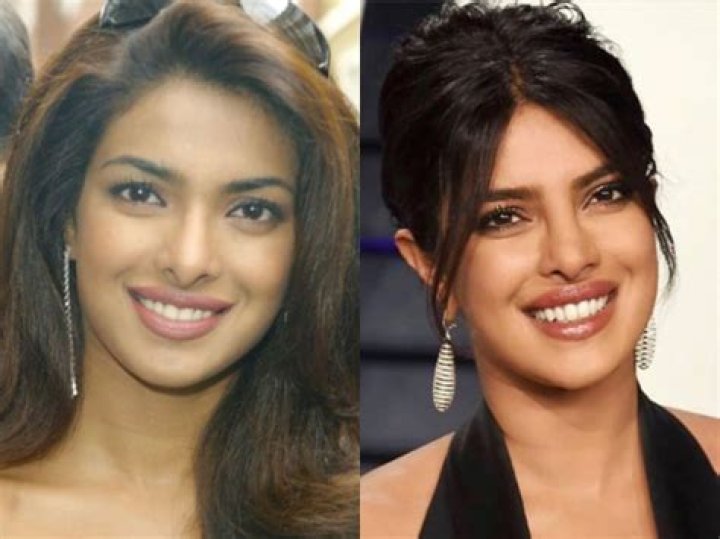 Priyanka Chopra.. Before and after plastic surgery!😳 Celebrity