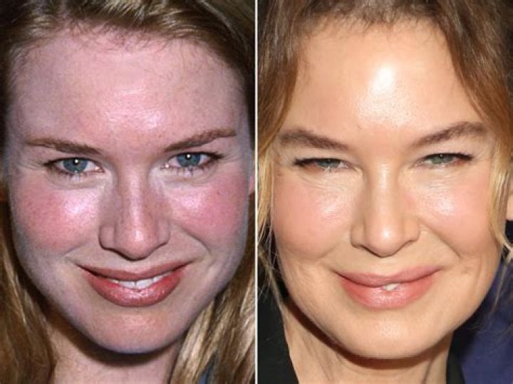 Ren&eacute;e Zellweger, Before and After Renee zellweger, Ren&eacute;e kathleen