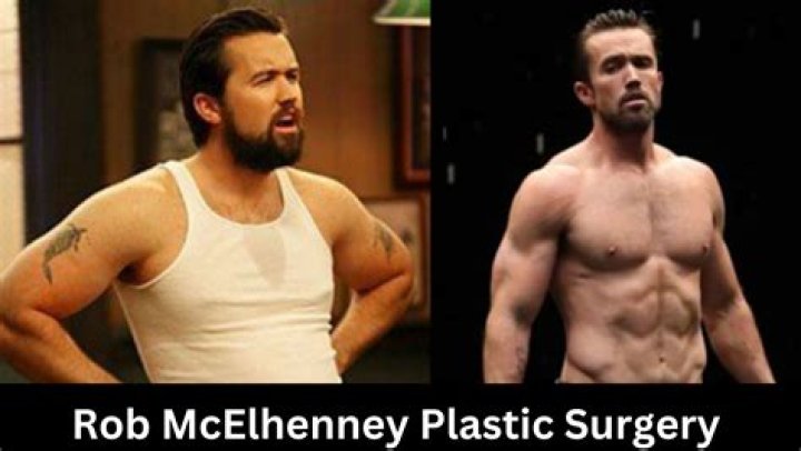 Rob McElhenney Plastic Surgery Surgical Tech