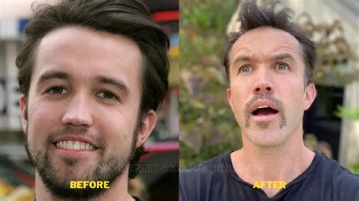 Rob McElhenney Plastic Surgery. Weight Loss And Health Update.