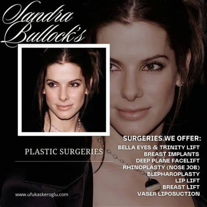 Sandra Bullock Frozen Face Result Of 'Fillers & Botox' Overload, Docs Claim