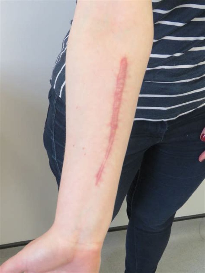 Selfharm scar revision BMJ Case Reports