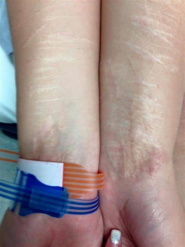 Selfharm St. John's woman bares scars on Facebook to end stigma CBC
