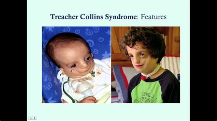 Treacher Collins Syndrome What Is Treacher Collins Syndrome?